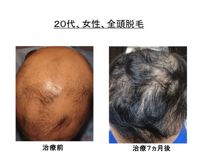 円形脱毛症　病院